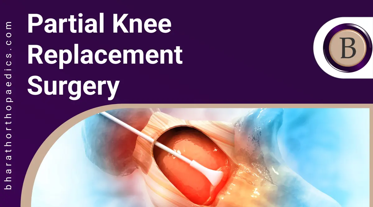 Partial Knee Replacement Surgery | Bharath Orthopaedics