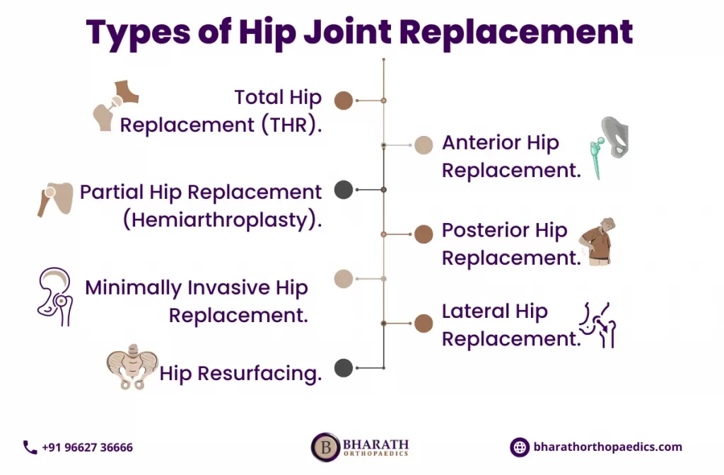 Hip Joint Replacement in Chennai | Bharath Orthopaedics