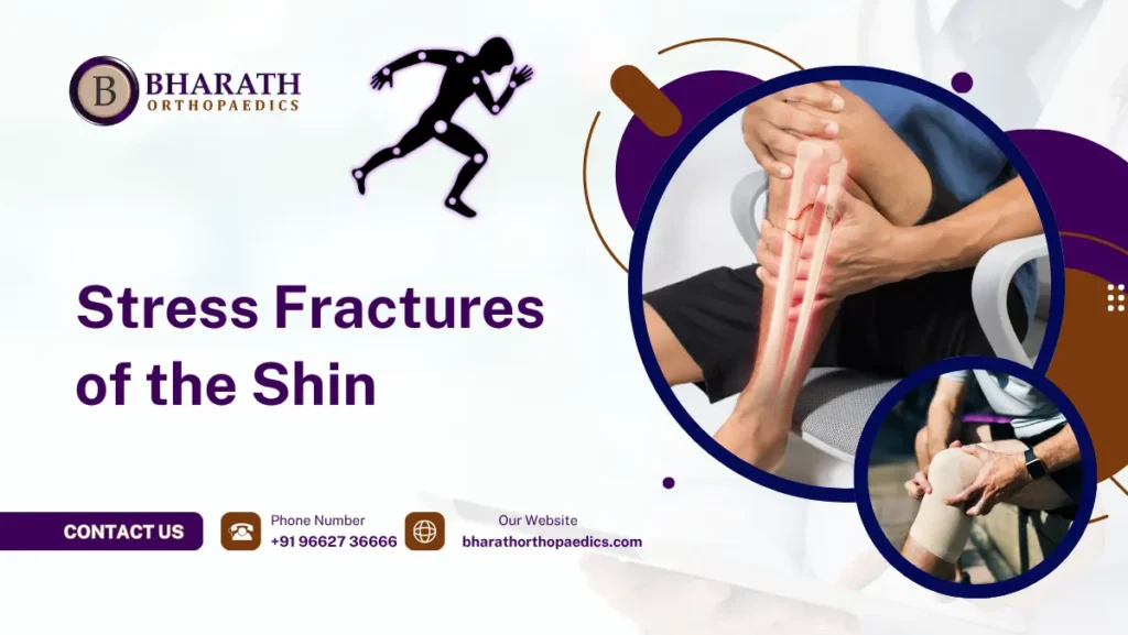 Stress Fractures of the Shin