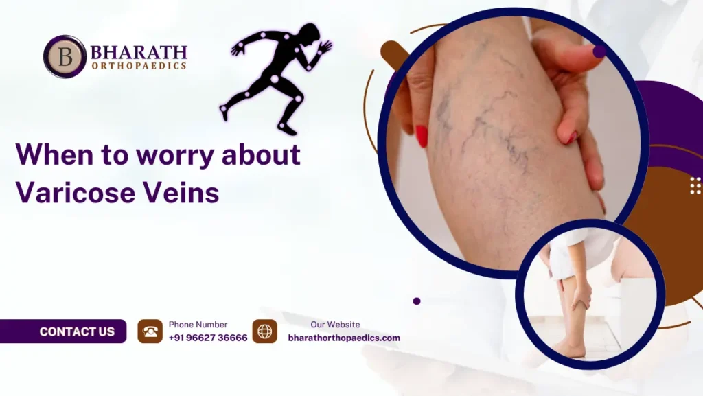 When to worry about Varicose Veins